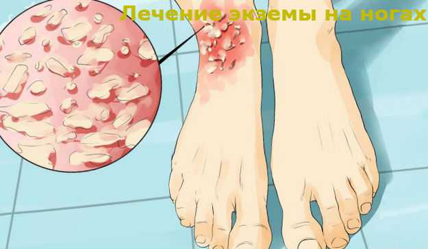 лечение экземы на ногах 