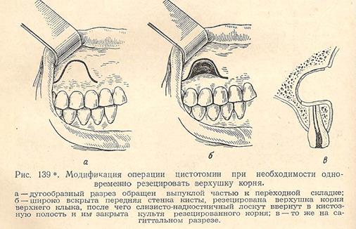 Можно ли вылечить кисту зуба без удаления