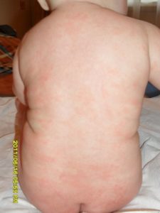 Чем и как вылечить атопический дерматит у ребенка