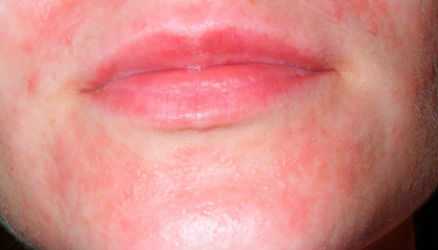 Аллергический тип контактного дерматита 
