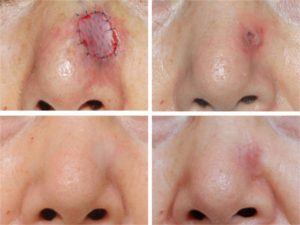 Причины и лечение базалиомы кожи носа