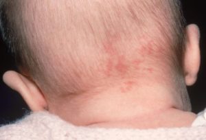 гемангиома у новорожденных на голове