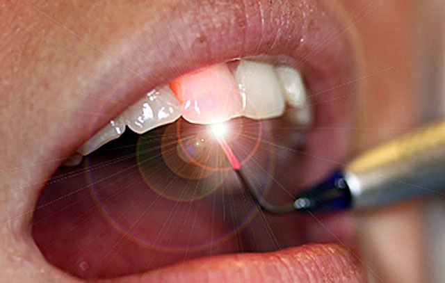 Особенности лазерного удаления кисты зуба