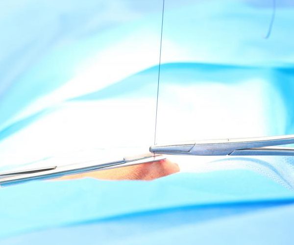 Особенности и преимущества обрезания лазером