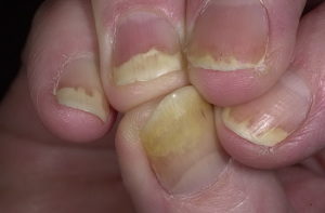 псориаз на ногтях