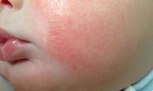 аллергический дерматит у ребенка