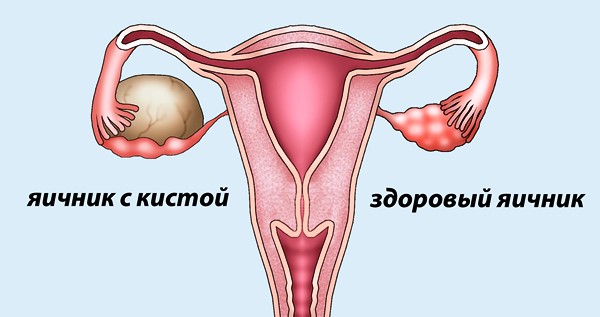 Киста левого яичника: симптомы и лечение образования у женщины
