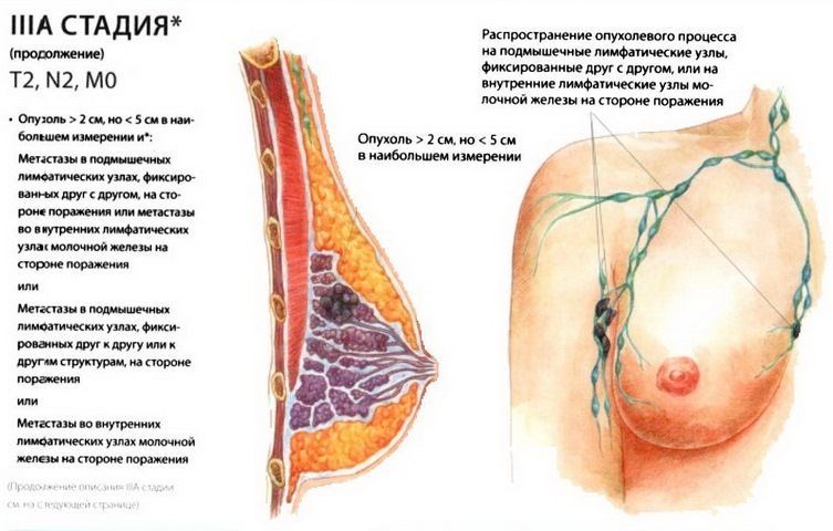опухолевый процесс в груди