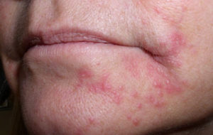 лечение перорального дерматита на лице