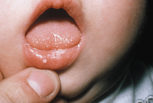 лечение герпеса на слизистой оболочке рта