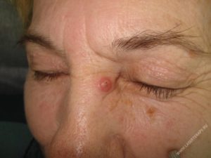 Базалиома кожи носа – симптомы, диагностика и лечение заболевания