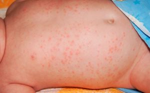 аллергическая сыпь на теле
