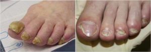 Симптомы и лечение микоза ногтей на ногах