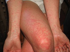 Симптомы вирусного дерматита у взрослых