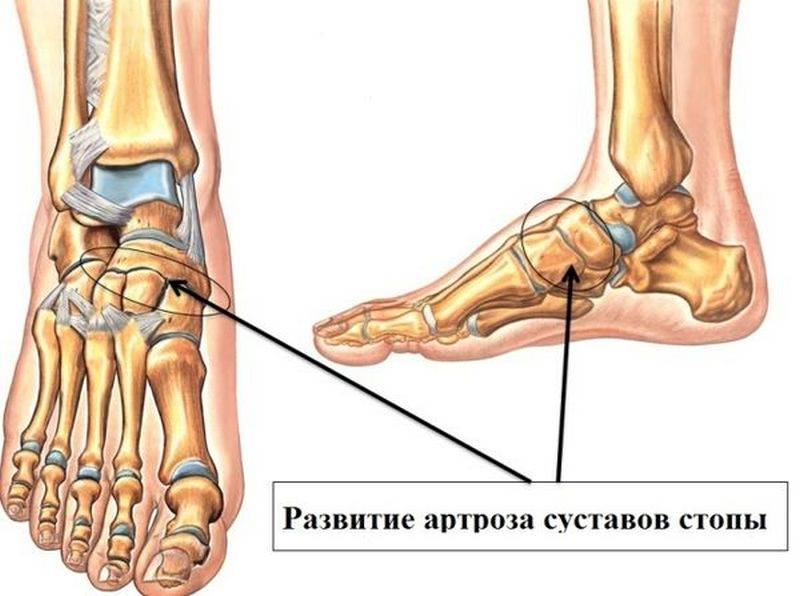 Артроз голеностопного сустава картинки