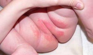 лечение пеленочного дерматита у детей