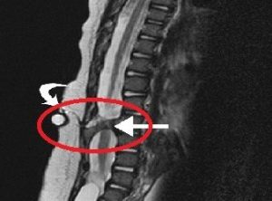 Spina bifida occulta: поддается ли лечению порок развития позвоночника?