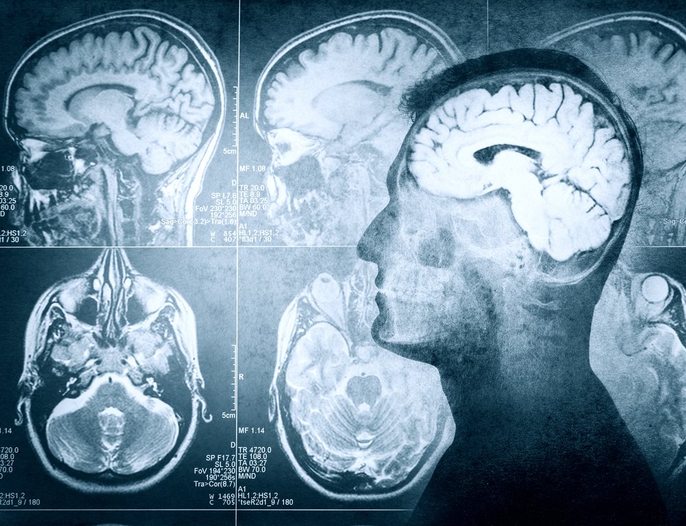 Какие последствия кисты прозрачной перегородки головного мозга