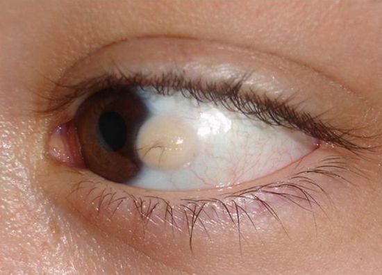 Причины кисты глаза и ее лечение