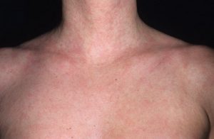 аллергическая сыпь на теле