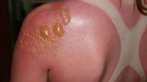 лечение буллезного дерматита