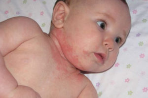 Чем и как вылечить атопический дерматит у ребенка