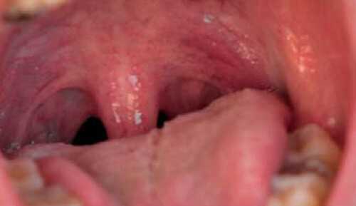 Лечение ожога нёба во рту