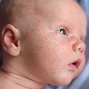 лечение красной сыпи на лице у ребенка