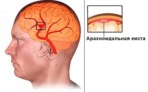 Что такое арахноидальная киста в головном мозге