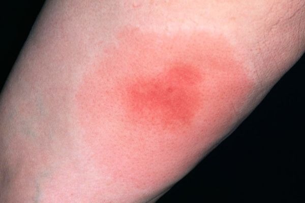 аллергия на укус клеща