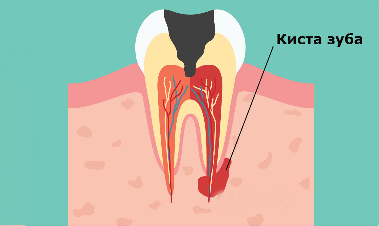 Что такое киста на зубе, какие виды бывают, лечение или удаление?