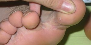 Грибок между пальцами ног лечение