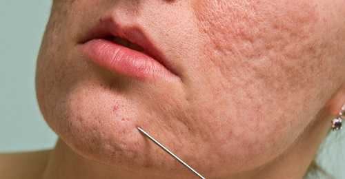 Лечение атрофических рубцов на лице