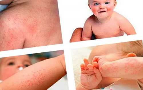 Аллергическая крапивница у детей