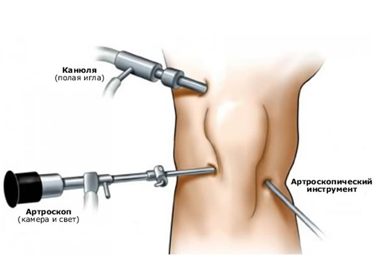 Атроскоп при операции на колене