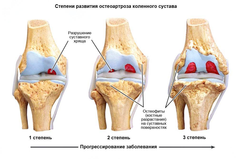 Разрушение коленного сустава