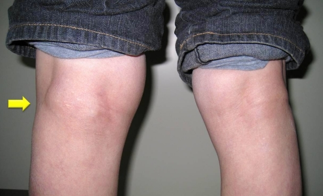 Почему возникает киста коленного сустава и какие ее виды бывают