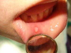 Симптомы и лечение герпеса на внутренней стороне губы 