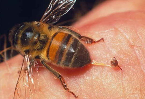 первая помощь после укуса пчелы