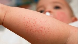 Симптомы и лечение вирусного дерматита у детей