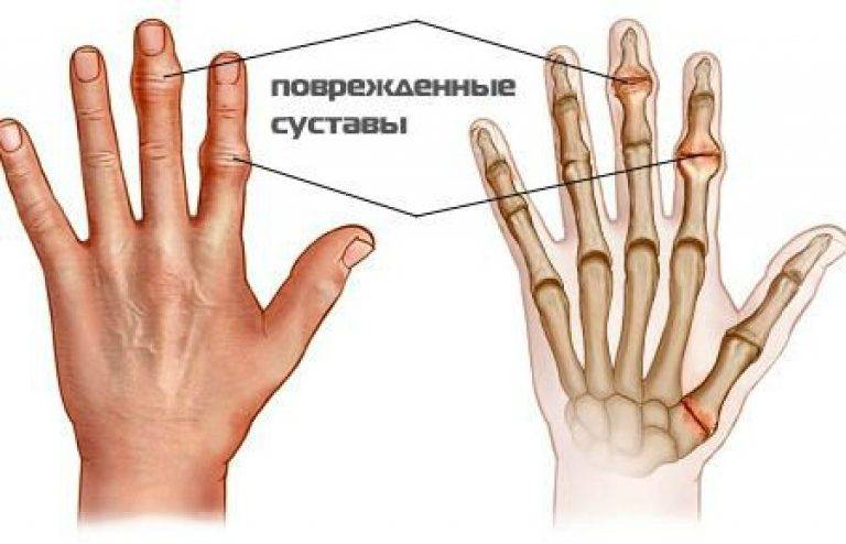 Остеоартроз пальцев рук фото