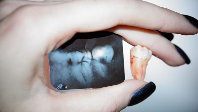 Как проводится удаления зуба с кистой