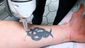  свести татуировку в домашних условиях без шрамов