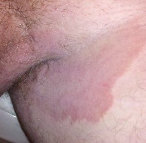 Симптомы и лечение пахового дерматита