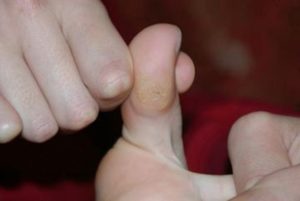 лечение наростов на пальцах ног
