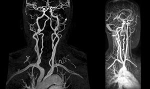 Спондилоартроз шейного отдела позвоночника: каковы последствия деформации и сращивания фасеточного сустава?