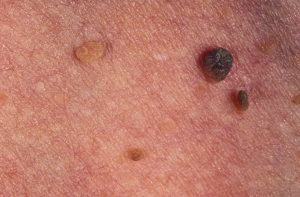 Симптомы и лечение папилломатоза кожи