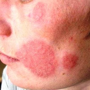 Каким должно быть лечение микоза кожи