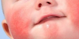 лечение вирусного дерматита у детей
